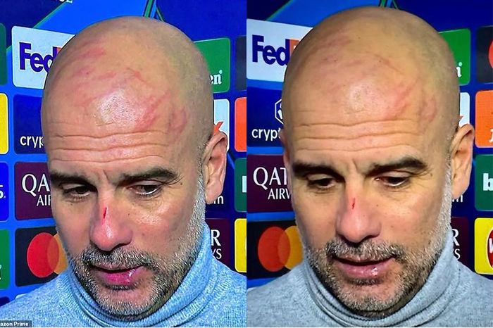 Pep Guardiola xuất hiện với nhiều vết thương gây chấn động: 'Tôi muốn tự làm mình bị thương'