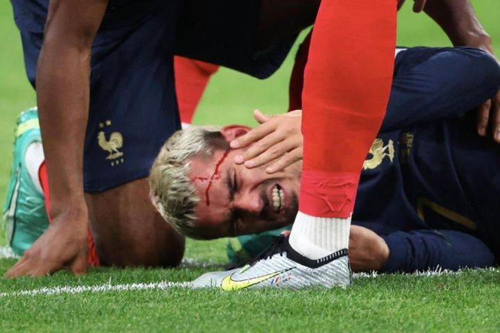 Griezmann đổ máu sau pha phạm lỗi thô bạo của hậu vệ Hy Lạp